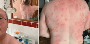 Mid Wales man survives more than 160 wasp stings