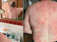 Mid Wales man survives more than 160 wasp stings