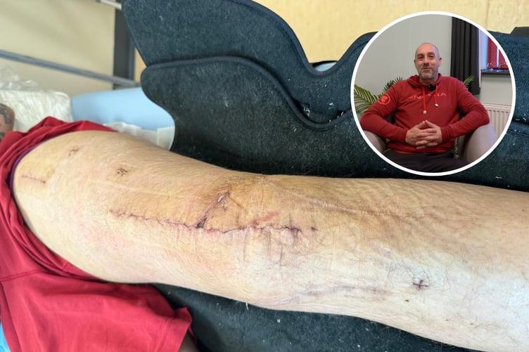Richard Hunt (inset) and his leg injury post-operation