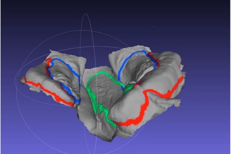 A computer model showing the mouth of a baby with a cleft lip