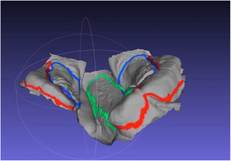 A computer model showing the mouth of a baby with a cleft lip
