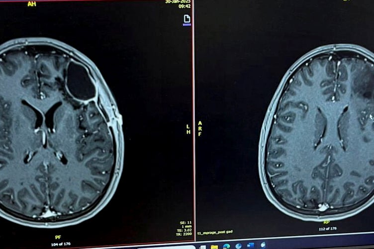 Moli's brain scan revealed she had a tumour. Moli said: "I'd booked a holiday with my boyfriend Ollie and we went away to Antalya in October last year. "We'd had a lovely week there, it was really relaxed and there was a water park at the hotel which was great.  "I felt absolutely fine and there were no warning signs for what was about to come the day before we were due to fly home. "I'd had trouble sleeping but felt OK apart from that and then I suffered a seizure at around 1am in the morning following by a second one about 20 minutes later.
