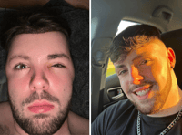 Abersoch man's post-transplant balloon face horror