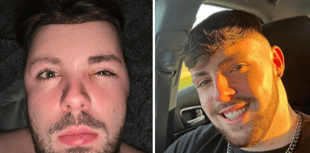 Abersoch man's post-transplant balloon face horror