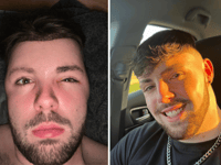 Abersoch man's post-transplant balloon face horror