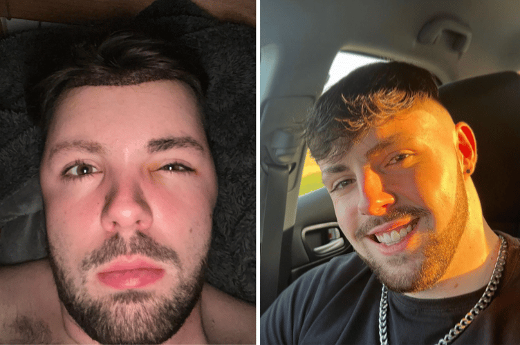 Left: Ruben Owen said his head swelled up when he ignored advice after a hair transplant. Right: Ruben Owen laughs about the incident now