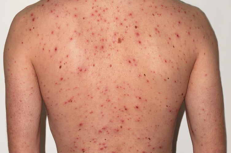 Chickenpox