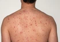Children to be offered chickenpox vaccination from January