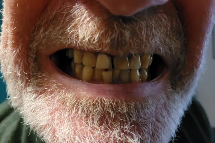 71-year-old Allan Mansbridge from Llanidloes has been quoted £4,000 to fix his deteriorating implants.