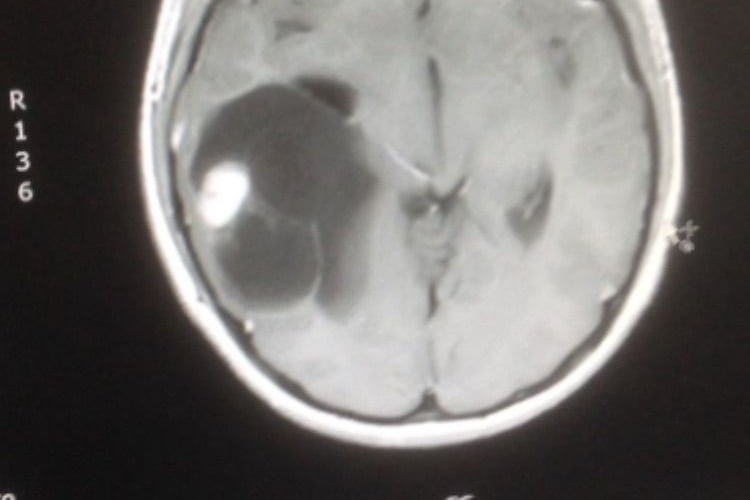 Brain Tumour Research