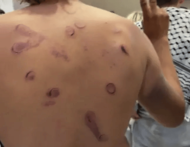 A livestream showing the abducted flotilla activists arriving in Istanbul reveals severe injuries which they allege were inflicted by Israeli forces.