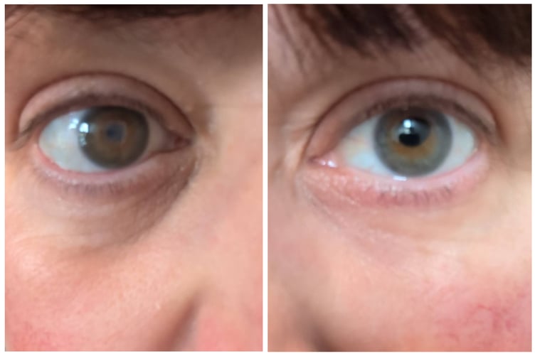 Her right eye has recently been treated with a corneal transplant, which has helped her vision but is still irritated by heat. Her left eye, without a transplant, is visibly cloudy.